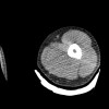 SPORK, NICO - 22.03.1976 - 02.08.2022 - CT obere Extremität - 17:56:57